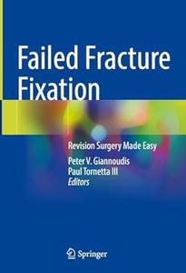 Failed Fracture Fixation Revision Surgery Made Easy