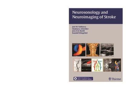 Neurosonology and Neuroimaging of Stroke Book  DVD