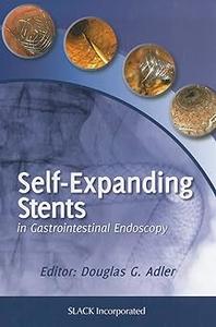 Self–Expanding Stents in Gastrointestinal Endoscopy