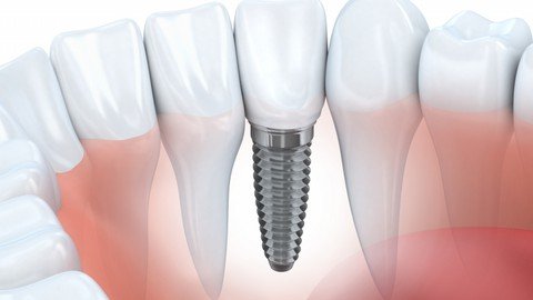 Dental Implants– A Prosthetic Makeover