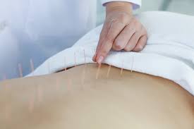 Acupuncture for relieving lower back pain and sciatica