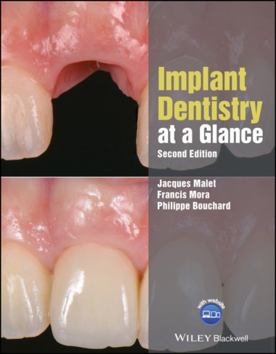 Implant Dentistry at a Glance / Edition 2 - Jacques Malet F662d655591107affeb00a2ad7bc4803