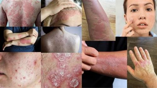 Recipes, Herbs, and Energy Exercise 4 common Skin Diseases