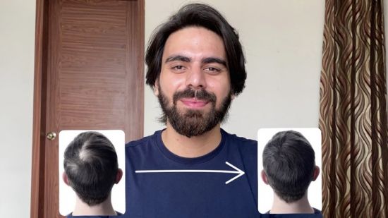 Complete Hair Loss Solution Program